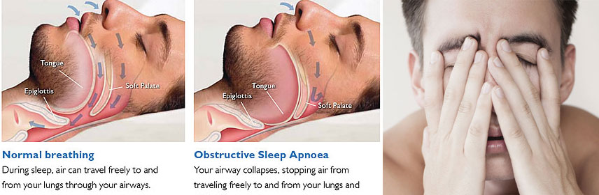 Medical Oxygen cylinder for sleep apnea